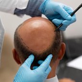 Hair Replacement hair system detail